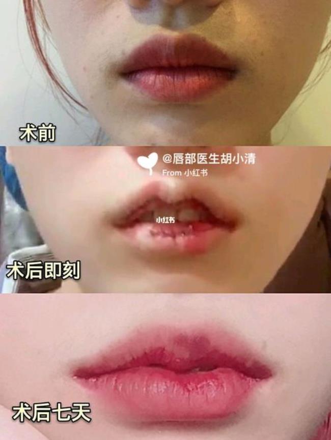 中国人嘴唇平均多厚