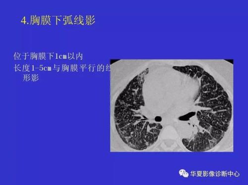 CT确诊间质性肺炎10个月，主要症状是劳力性呼吸困难{气喘}