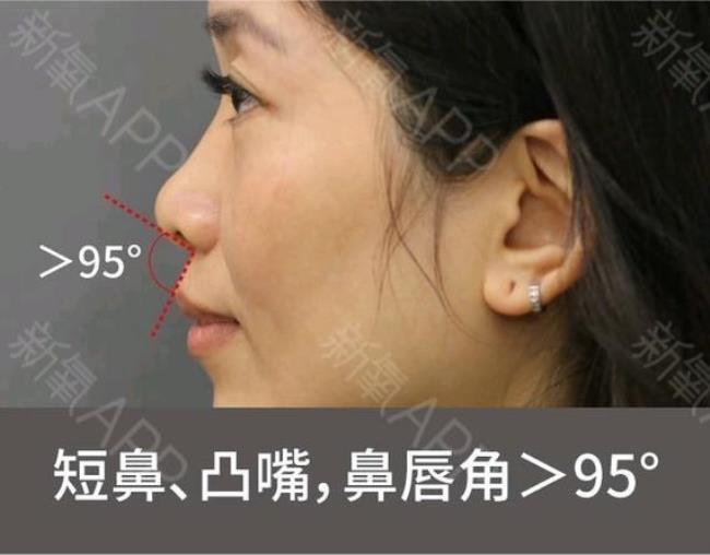 亚洲人有天生高鼻梁吗