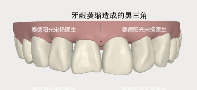 牙齿黑三角怎么补救