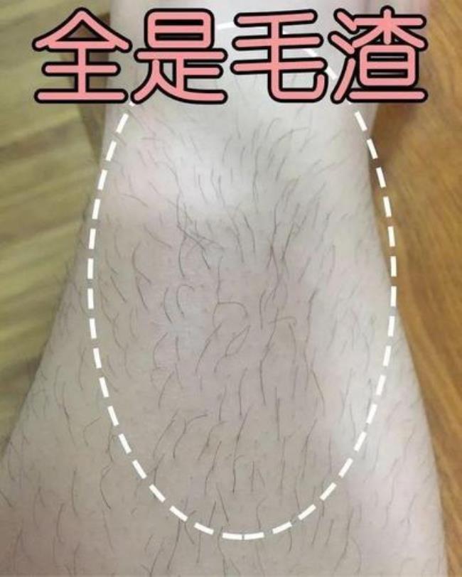 怎么去腿毛