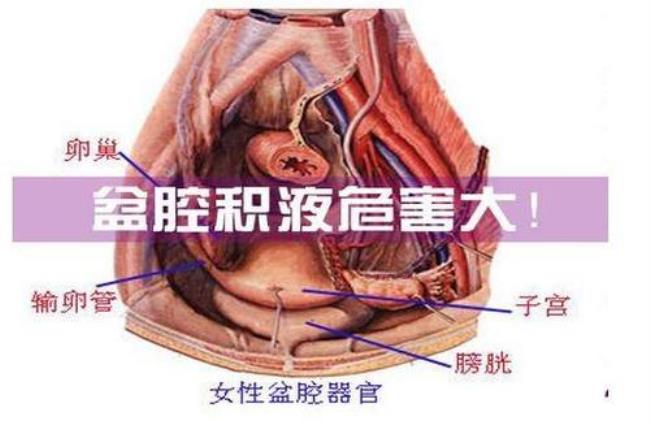 盆腔积液怎么抽出来