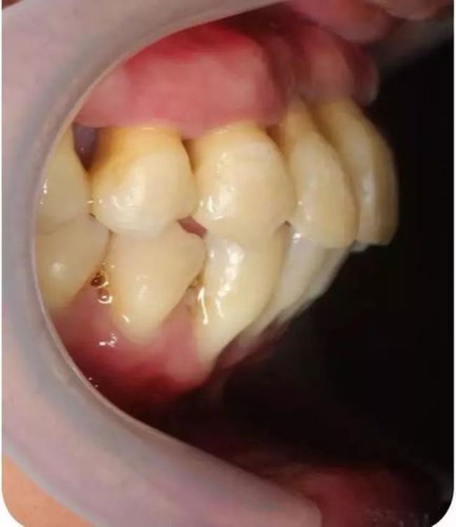 牙周炎是什么