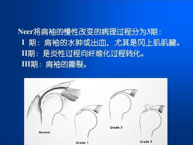 肩袖损伤和肌腱断的区别