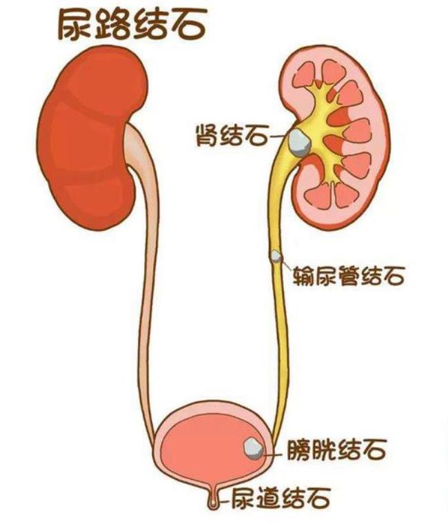 肾结石疼痛如何缓解