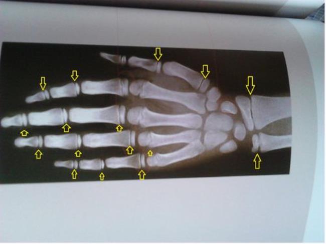 怎样看骨龄片子測骨龄