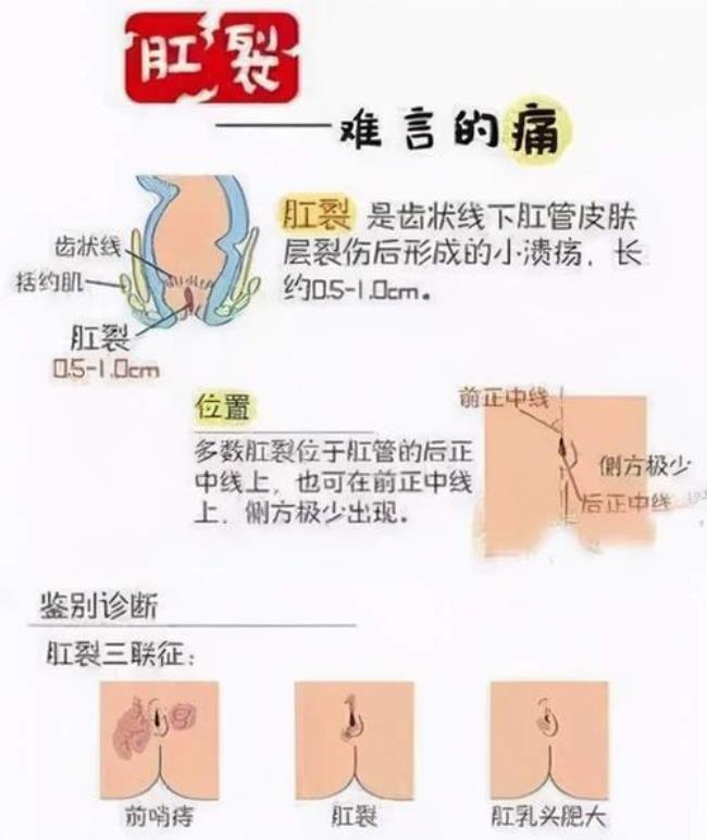 痔疮和肛裂怎么区分