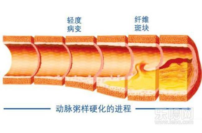 动脉硬化有什么危害