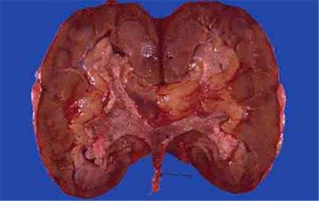 肾囊肿怎么治效果比较好