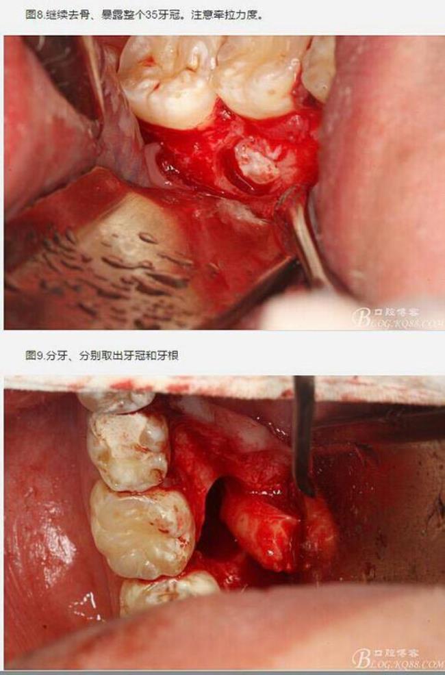 牙根囊肿手术多久可以恢复