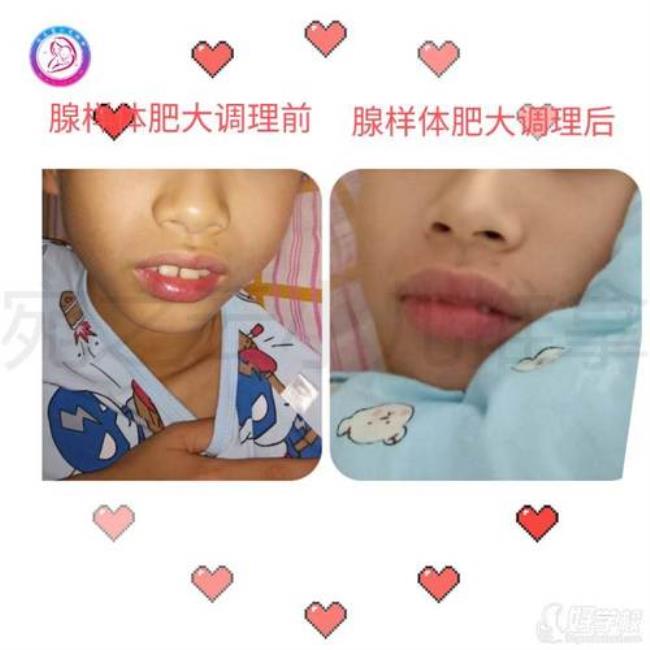 鼻炎腺样体肥大如何治疗