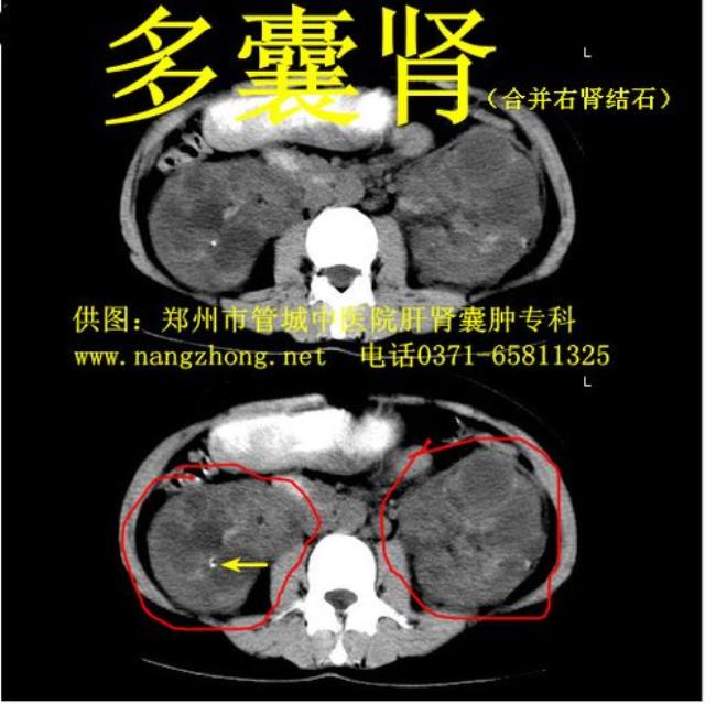 肾囊肿是什么