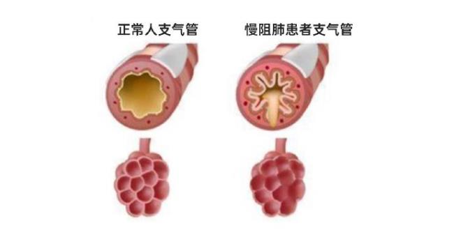 轻微肺气肿能治好吗