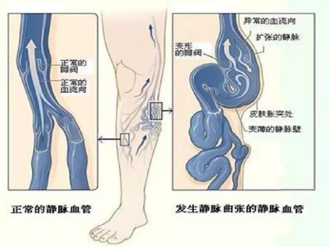 静脉曲张怎样治疗