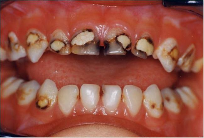 儿童蛀牙怎么回事