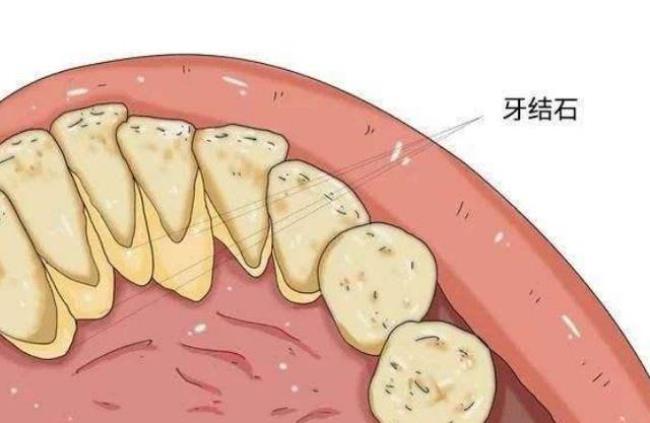 如何有效去除牙结石