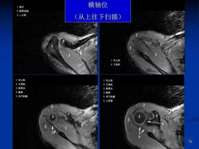 肩袖轻微损伤能自愈吗