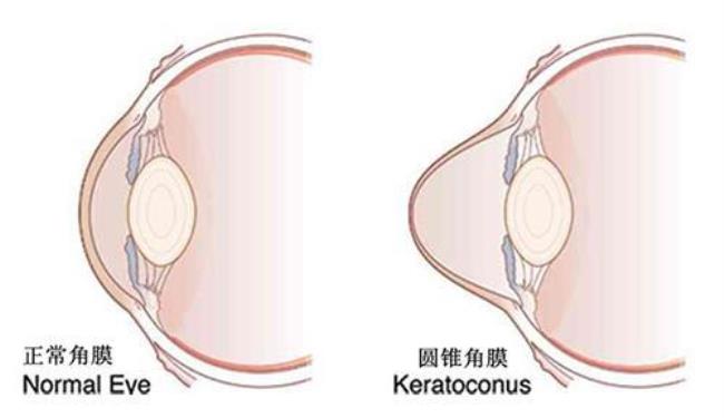 什么叫圆锥角膜交联手术