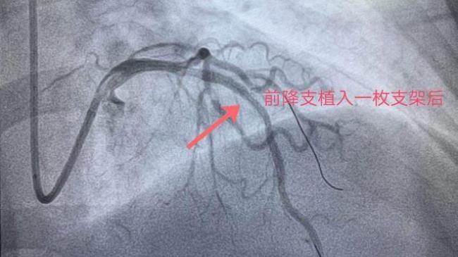 冠状动脉管壁钙化怎么办