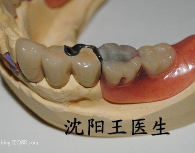 mk1精密附着体制作过程