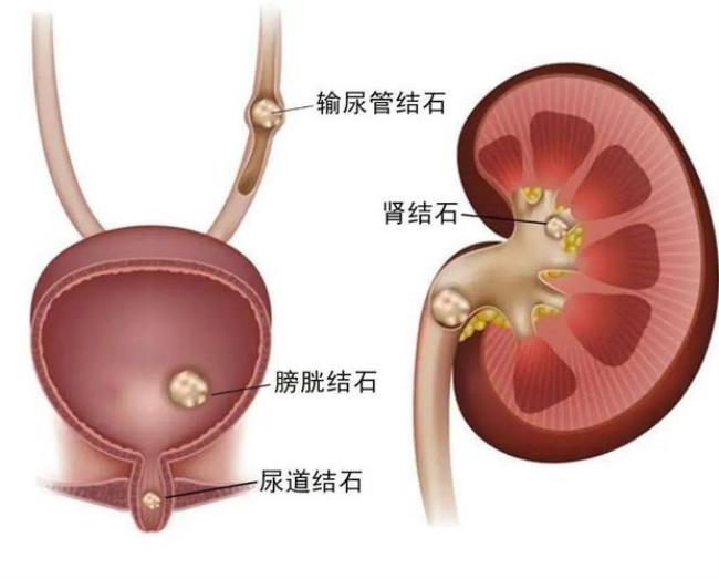 结石卡在尿道怎么办