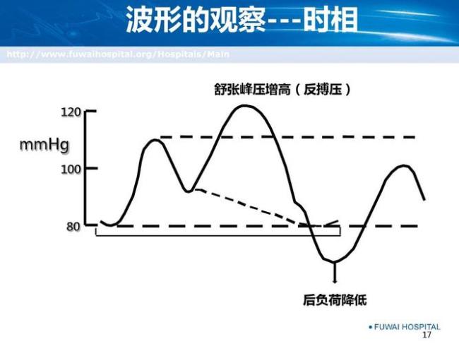 iabp最常用的触发模式