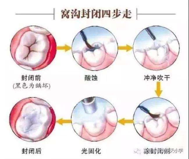 儿童窝沟封闭有必要么