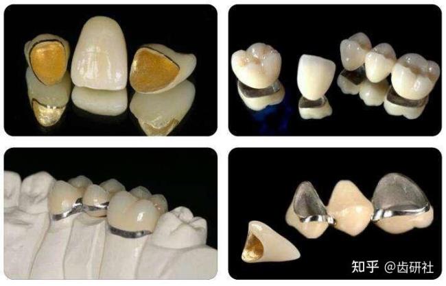 全瓷牙怎么选择适合自己的