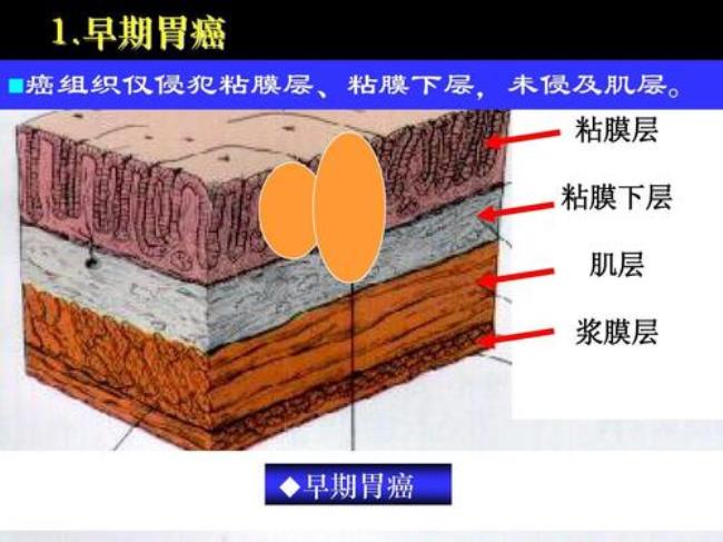 粘膜肌层和固有肌层的区别