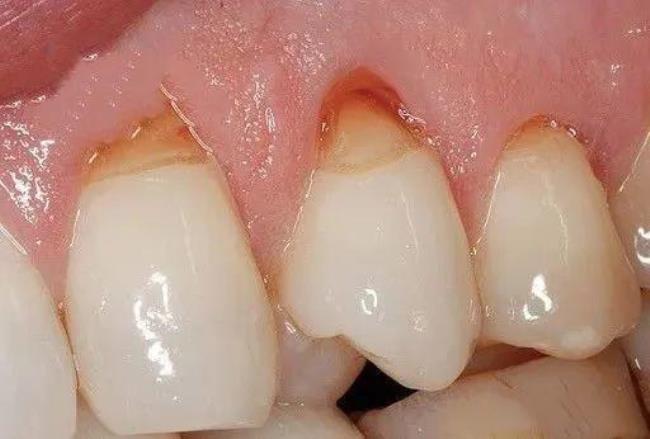 如何防治牙齿楔形缺损