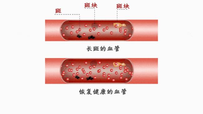 血管有斑块怎么办