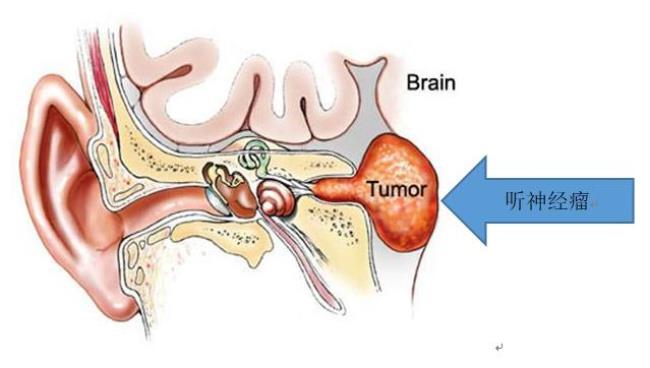 听神经瘤是怎么造成的