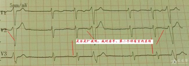 房早三联律怎么治疗