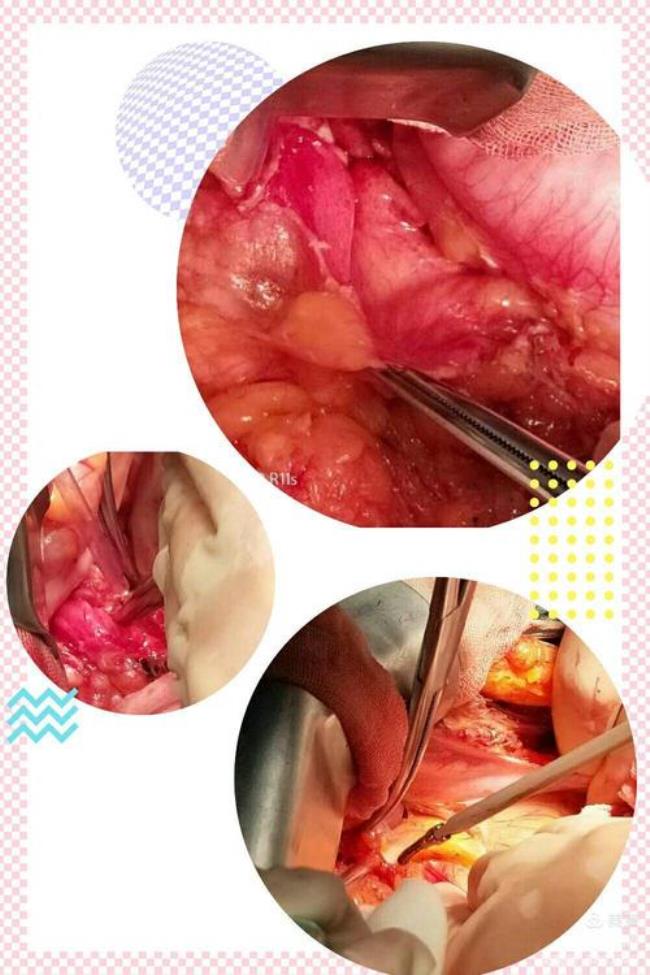 胰腺体尾部囊腺瘤手术难度如何