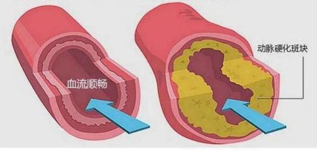 如何检查脑动脉硬化