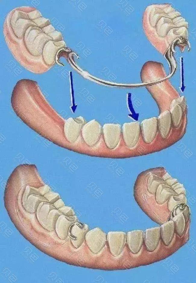 临时性固定假牙有什么作用