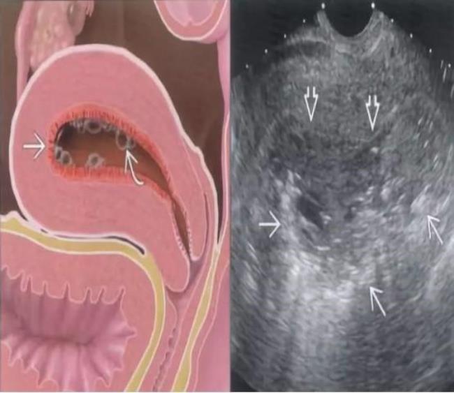 子宫里有水是怎么回事