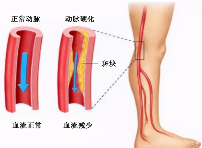 大腿动脉的位置