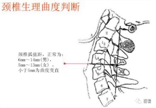 颈椎生理弧度变直怎么回事