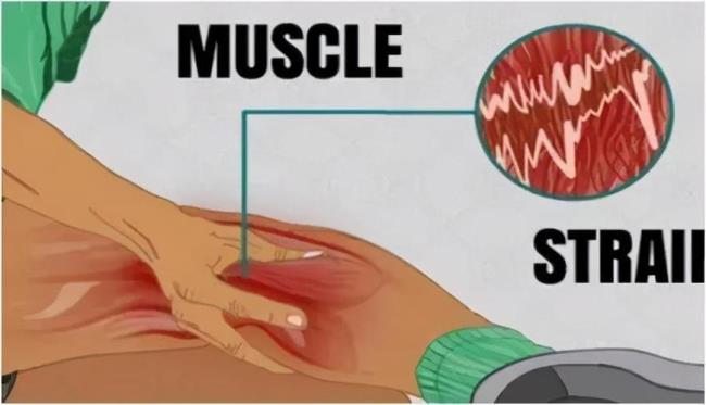 腿部肌肉拉伤怎么快速恢复