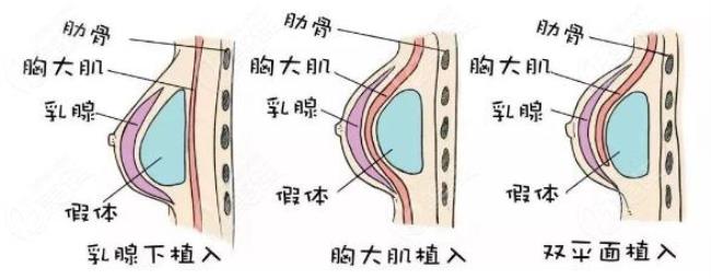 胸部切除需要多少钱