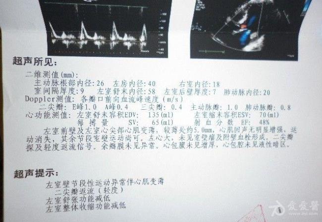 做心脏彩超能查出心梗吗