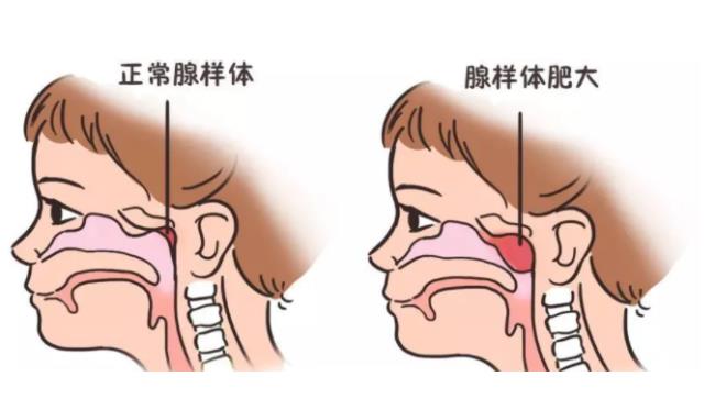 腺样体肥大最佳治疗方法