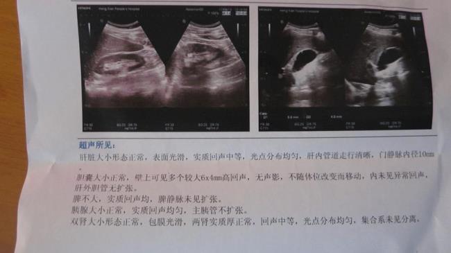 胆囊隐隐作痛是怎么回事