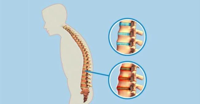 退行性脊柱炎怎么治