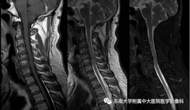 脊髓半切综合征怎么回事