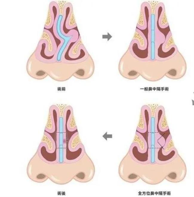 鼻中隔偏曲手术步骤有哪些