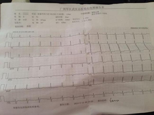 窦性心律怎么回事