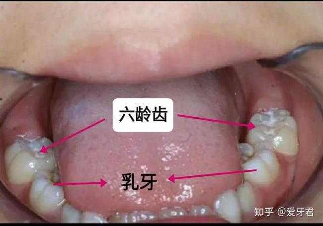 六龄牙什么时候长出