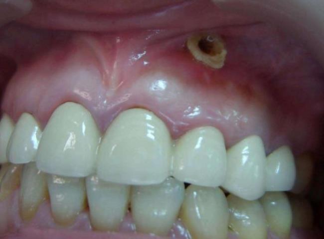 牙龈鼓脓包应该怎样治疗